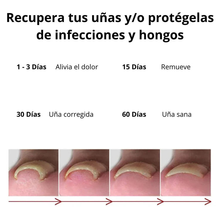 Tratamiento para eliminar Hongos de uña 100% Natural🍃